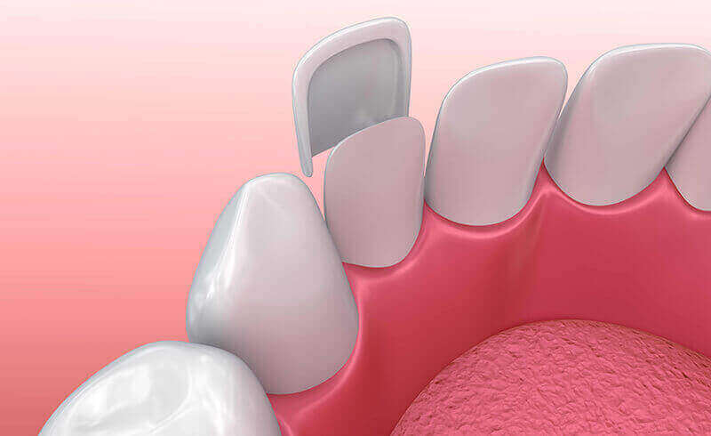 Dental Veneers Dryden